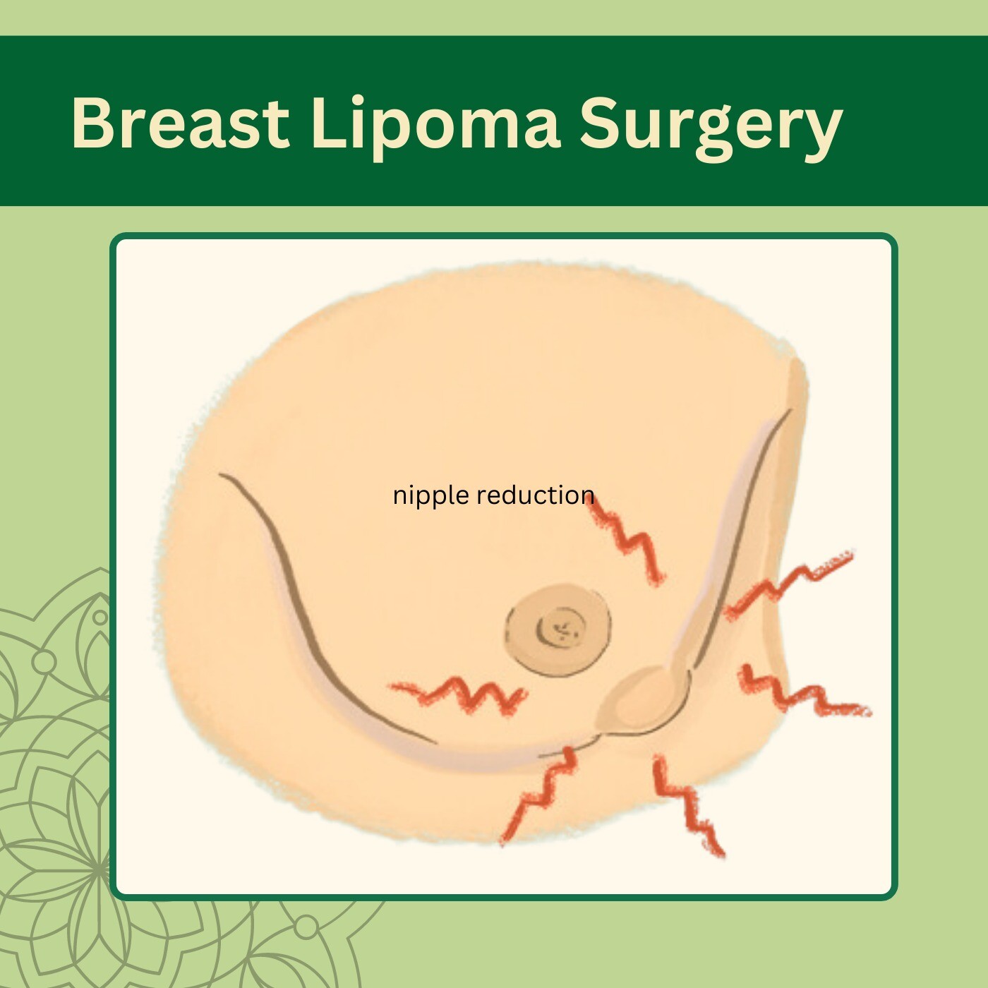 Breast Lipoma Surgery, Less Scar Result, Lipoma Removal, Ahmedabad, Rajkot, Vadodara, Surat, Gujarat.