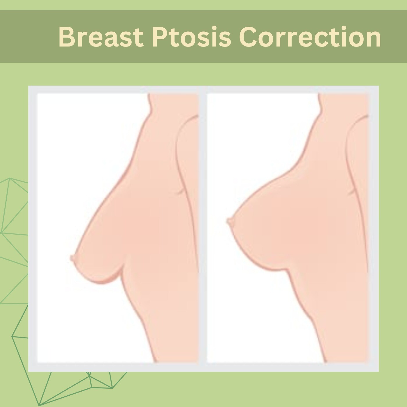 Breast Ptosis Correction, Breast Implant Surgery , Auto Augmentation, Mumbai, Akola, Surat, Dwarka, India.