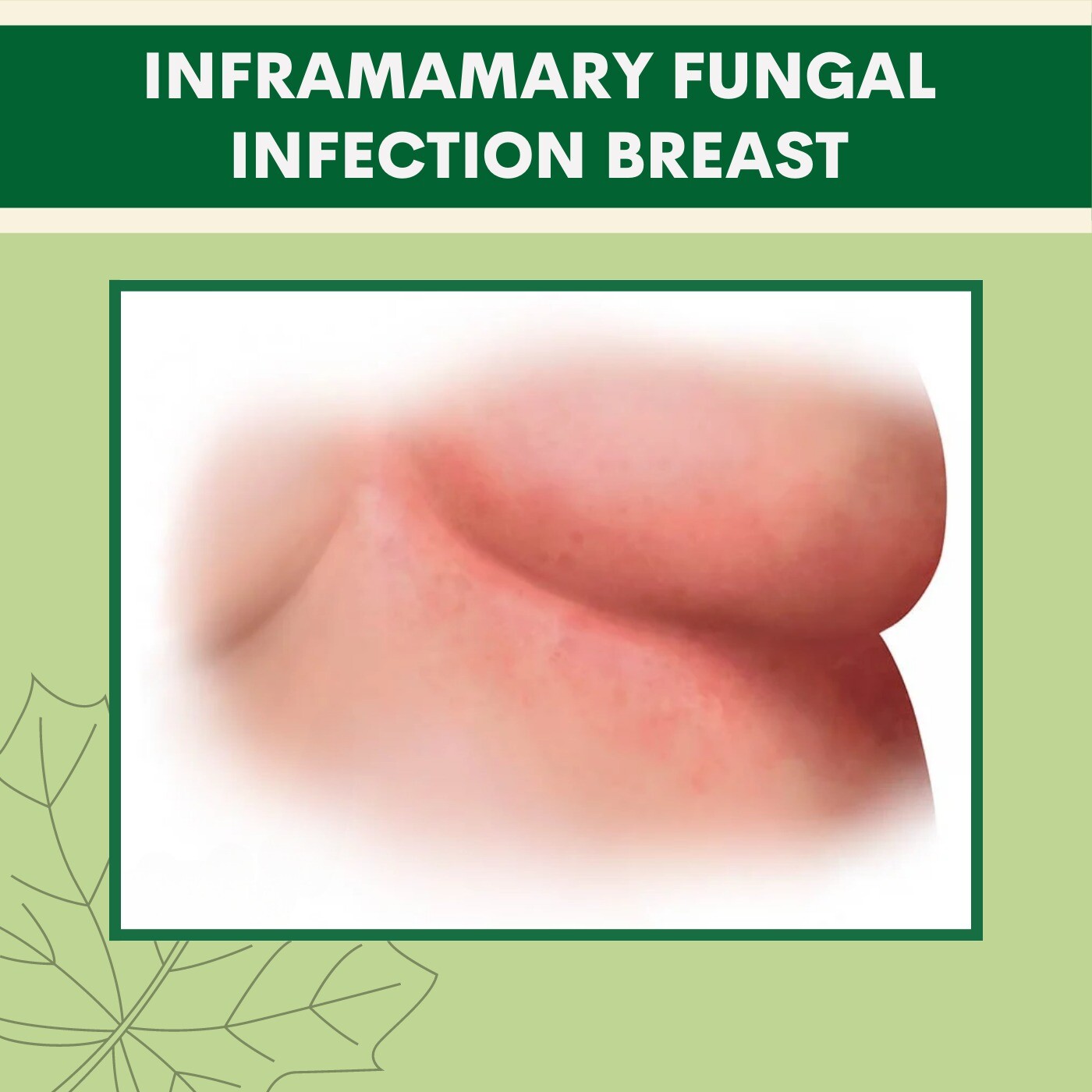 Inframamary Fungal Infection Breast, Red skin rash, Breast Reduction Surgery, Ranchi, Raipur, Shivpuri, Surat, India. episode artwork