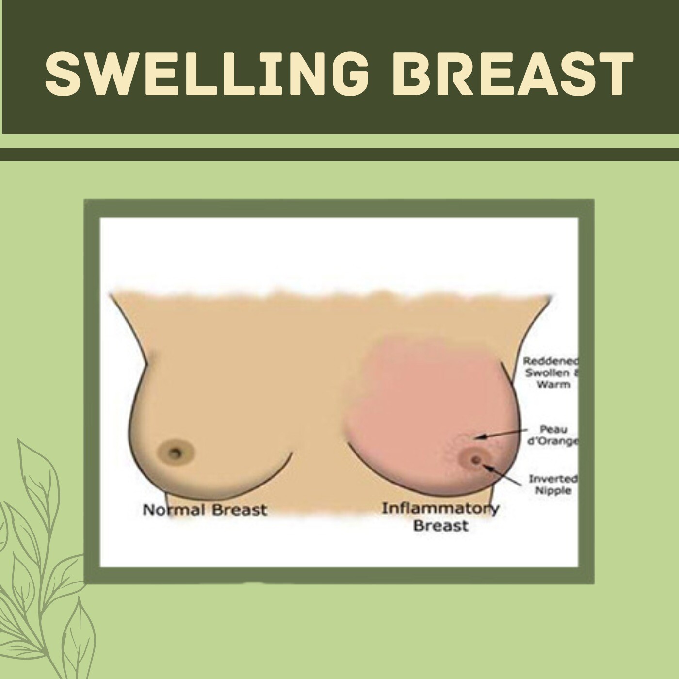 Swelling Breast, Breast Tumor, Breast Fibroadenoma, Mumbai, Ahmednagar, Aurangabad, Surat, India. episode artwork