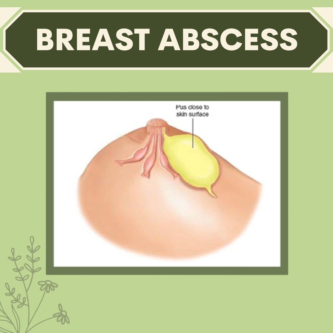 Breast Abscess, Inflamed Breast Tissue, Scar Less Result, Jaipur, Bhopal, Nagpur, Ambikapur, Surat, India. episode artwork