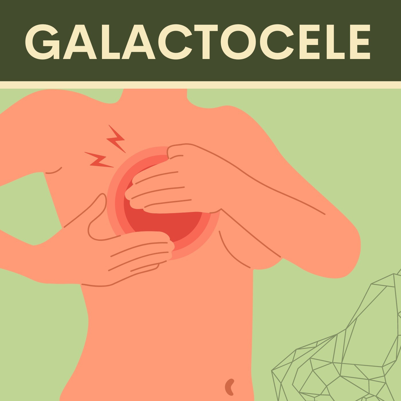 Galactocele, Breast Surgery, Painless lump, Mundra¸ Chapra, Akola, Surat, India. episode artwork