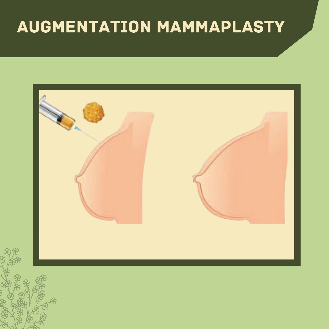 AUGMENTATION MAMMAPLASTY, Breast Implant, Auto Augmentation, Fat Transfer, Bhavnagar, Jamshedpur, Azamgarh, Surat. episode artwork