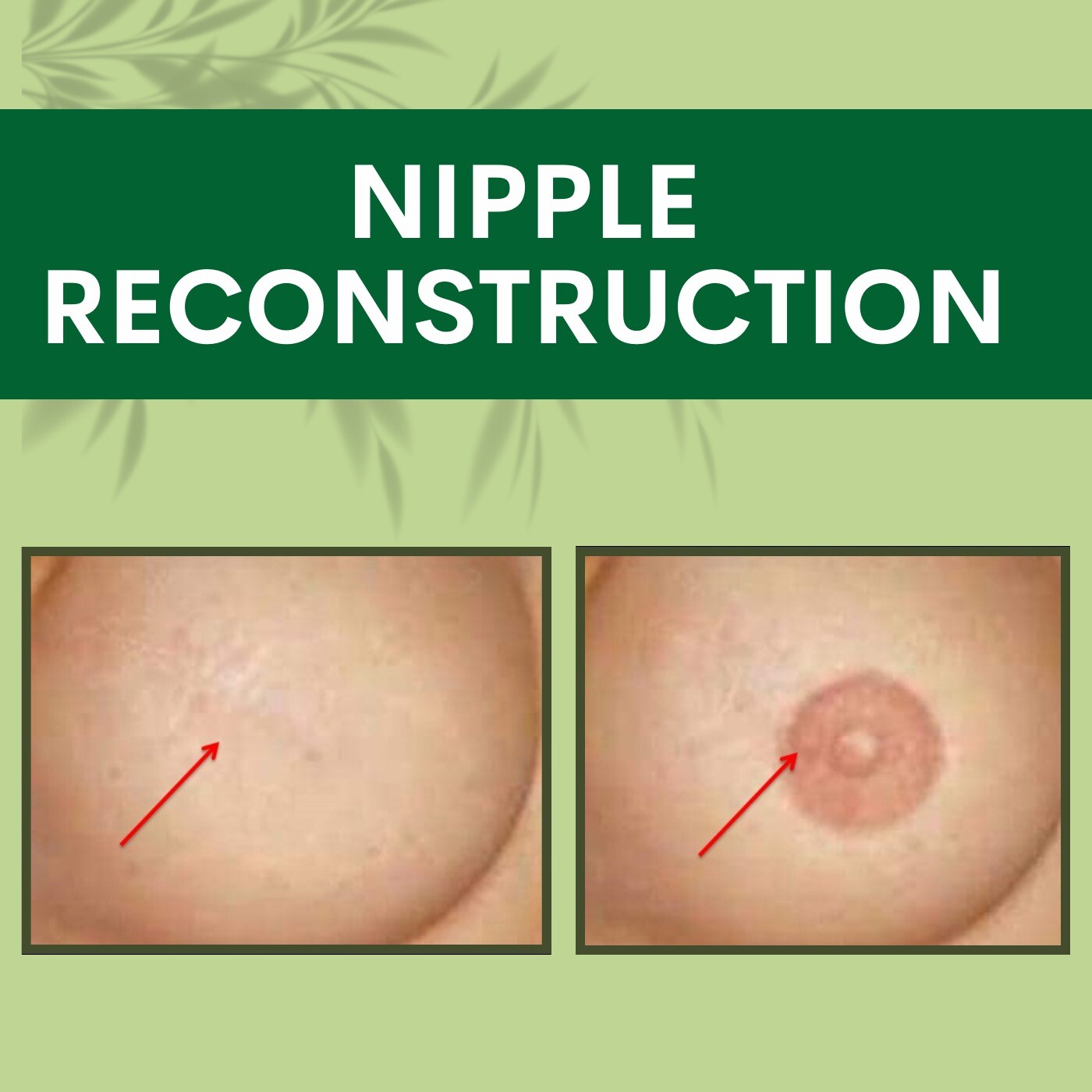 Nipple Reconstruction, Post Burns Breast Reconstruction, Anesthesia Procedure, Jabalpur, Ratlam, Bhagalpur, Surat, India.