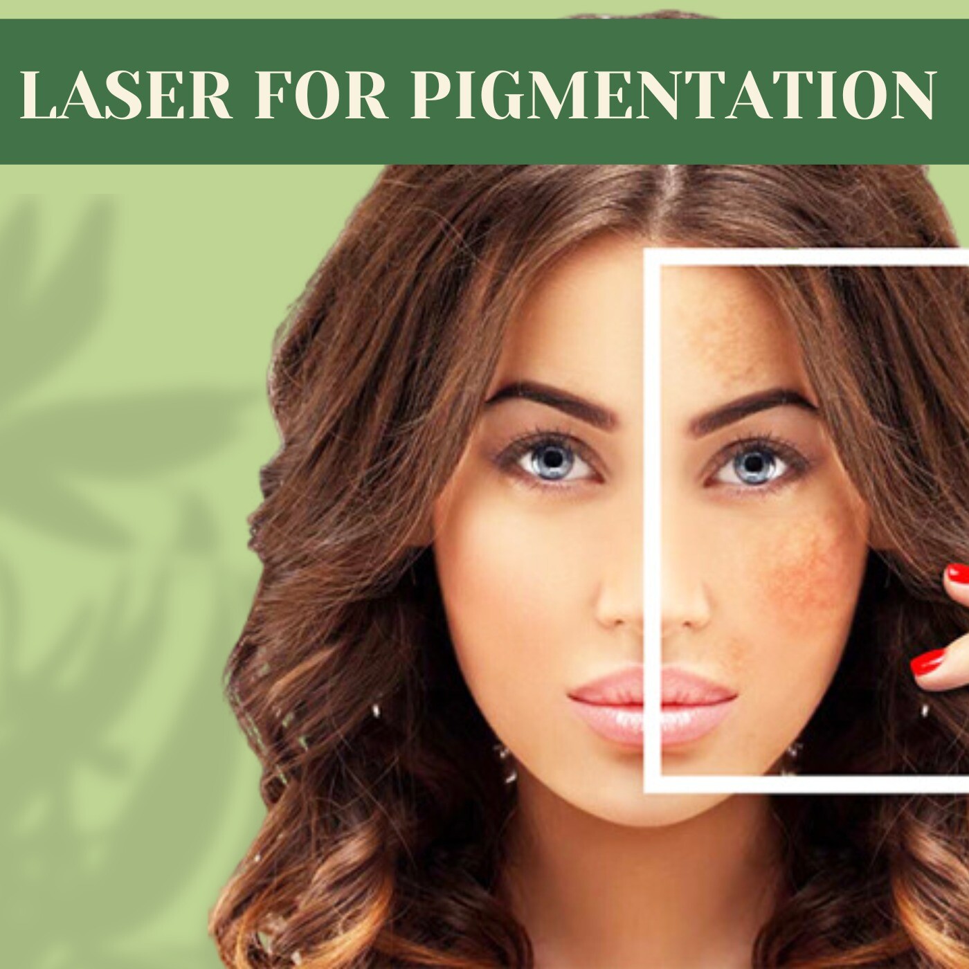 Laser For Pigmentation, Hyperpigmentation Laser Therapy, Reducing Pigmentation, Ranchi, Nashik, Surat, India.
