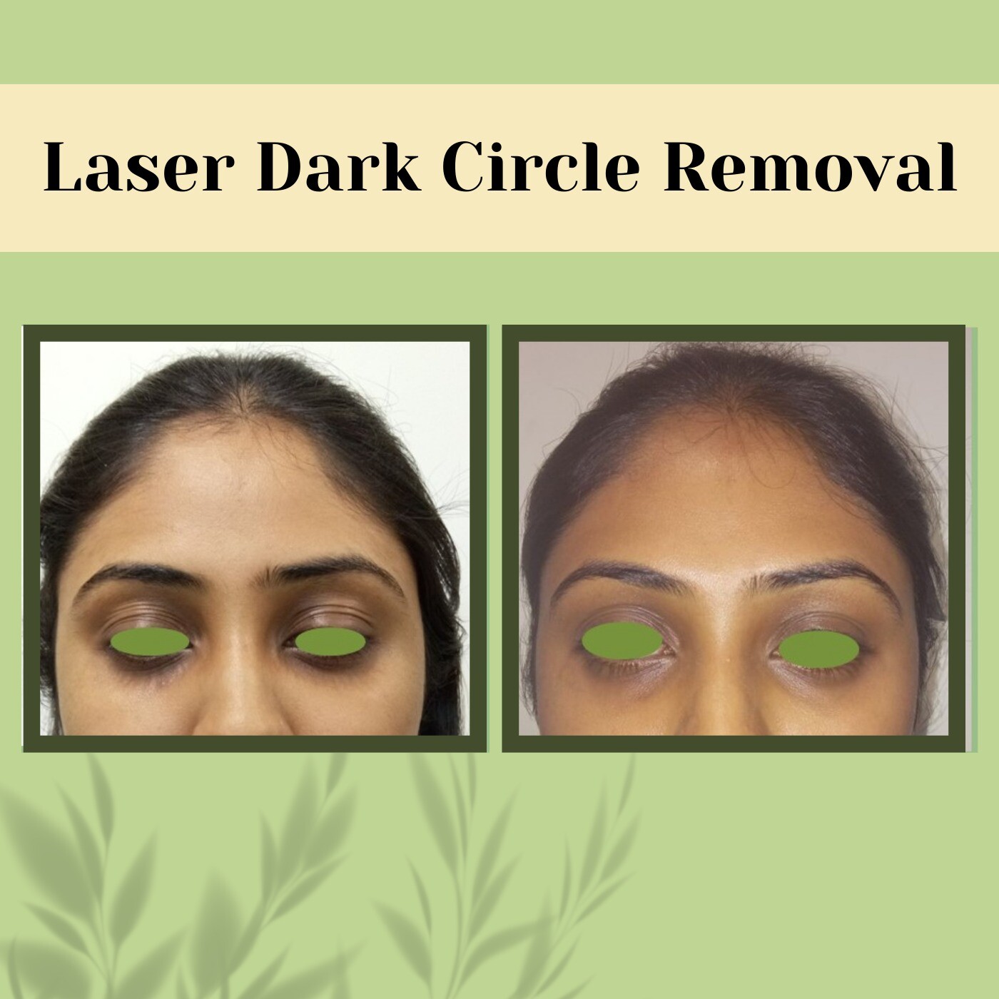 Laser Dark Circle Removal, Under-Eye Laser Therapy, Dark Circle Reduction, Jamshedpur, Satara, Surat, India. episode artwork