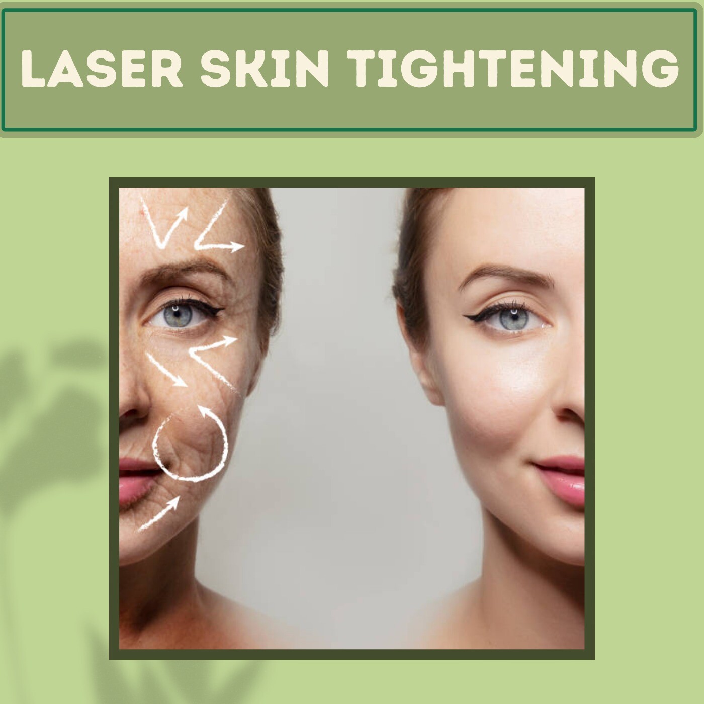 Laser Skin Tightening, Skin Rejuvenation, Fine Lines Procedure, Pune, Mandsaur, Nanded, Chapra, Surat, India. episode artwork