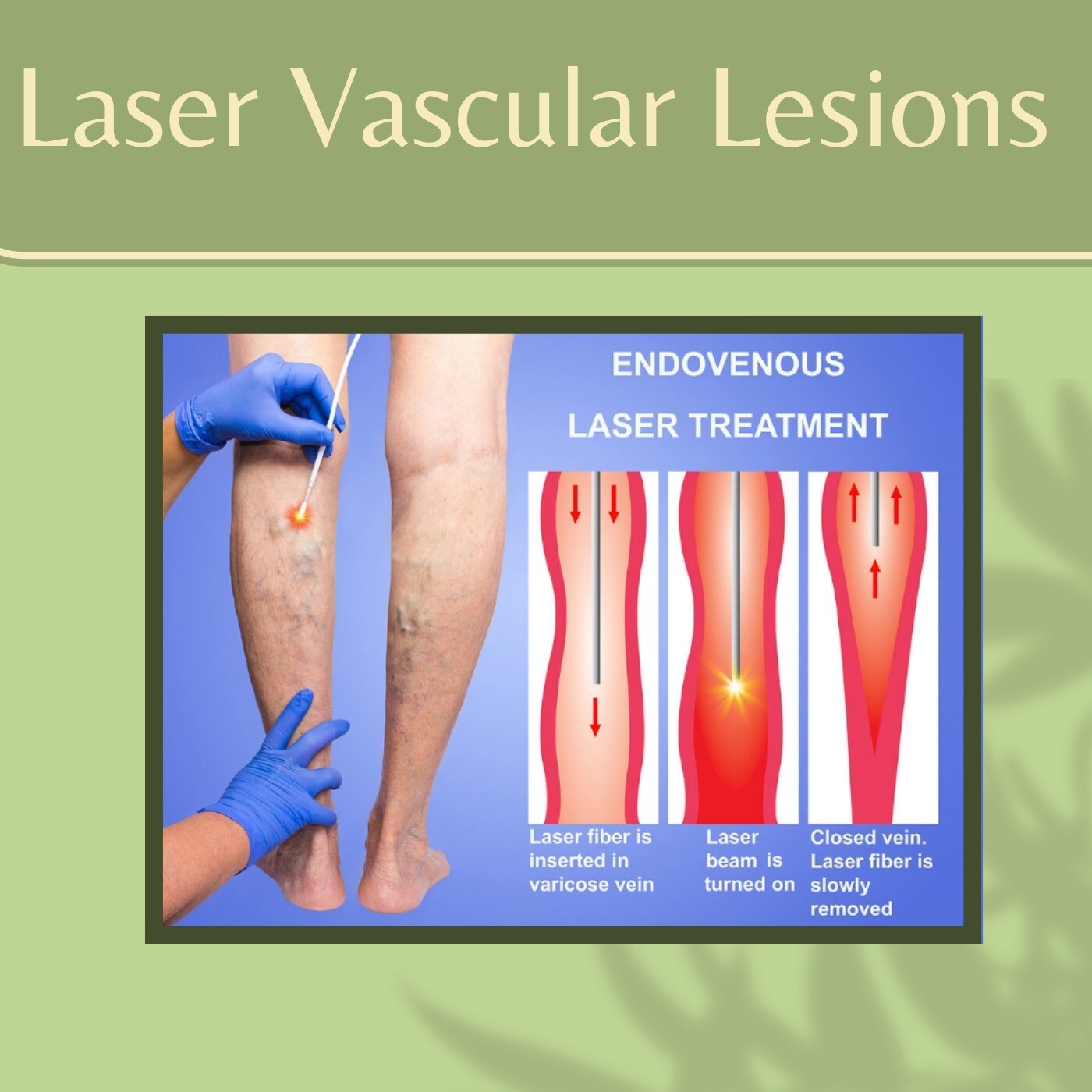 Laser Vascular Lesions, Pulsed Dye Laser, Laser Vascular Lesions, Mehsana, Ajmer, Ranchi, Surat, India. episode artwork