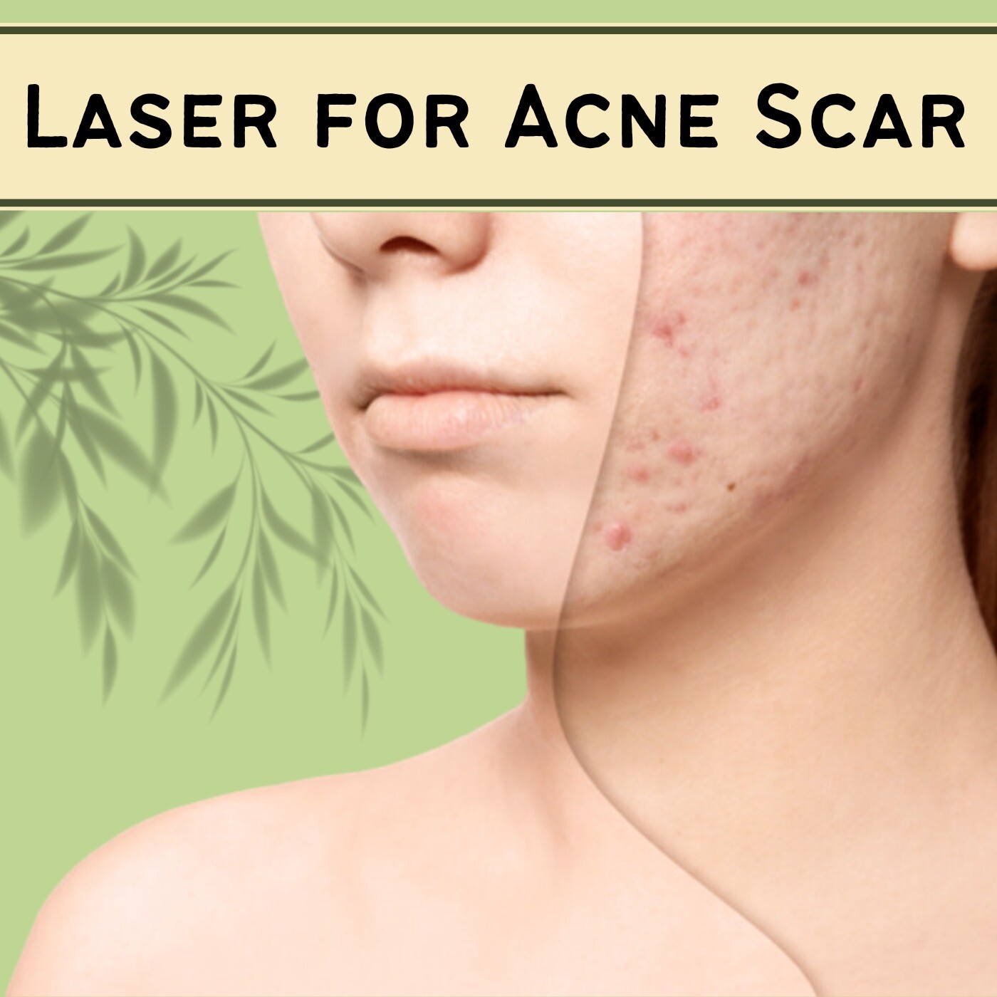 Laser For Acne Scar, Skin Resurfacing, Fat Grafting Procedure, Raipur, Dwarka, Pune, Surat, India. episode artwork