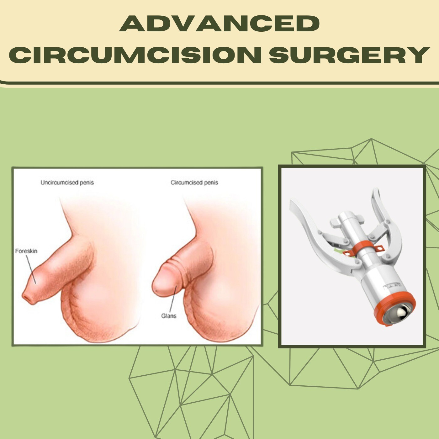 Advanced Circumcision Surgery, Uneven Scar, Urinary Problems, Mundra, Jabalpur, Nanded, Surat, India.