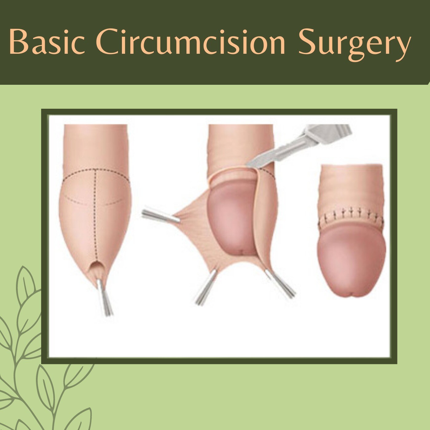 Basic Circumcision Surgery, Age Old Method, Less Bleeding Procedure, Gandhidham, Bhopal, Dhule, Surat, India. episode artwork