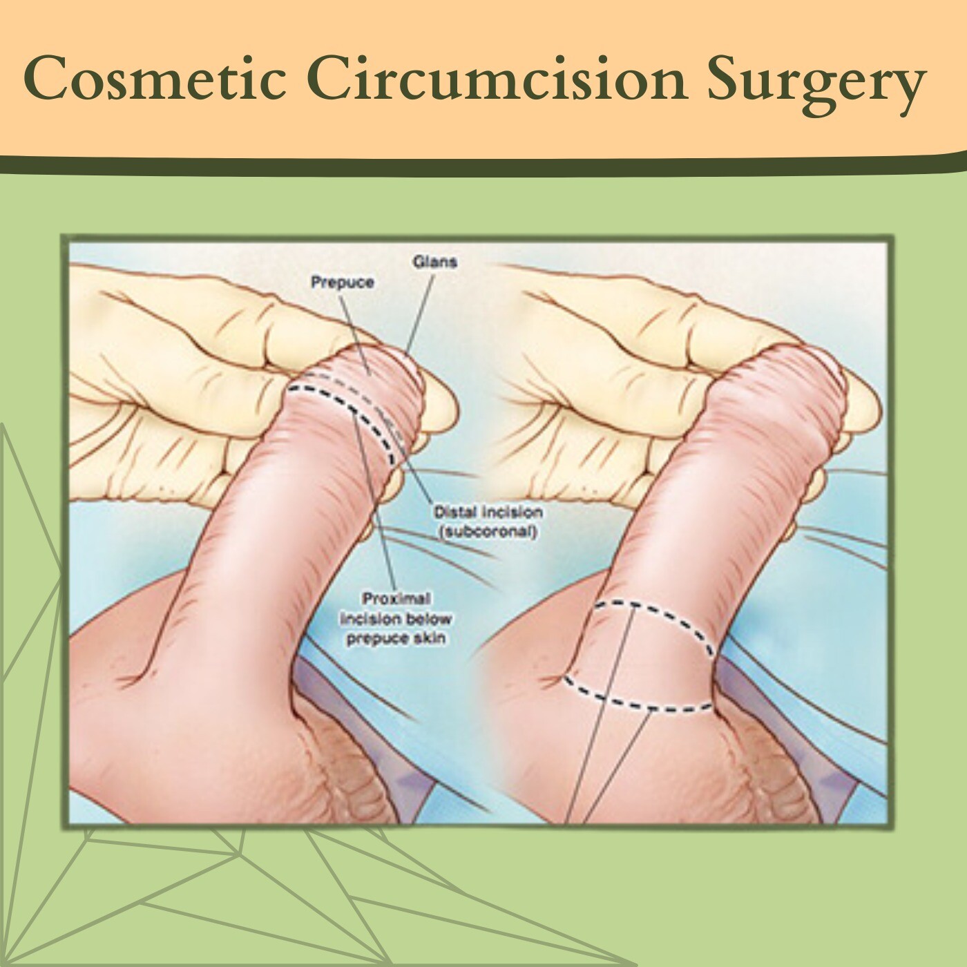 Cosmetic Circumcision Surgery, Alisklamp, Stitchless Circumcision, Bhuj, Ratlam, Nagpur, Surat, India. episode artwork