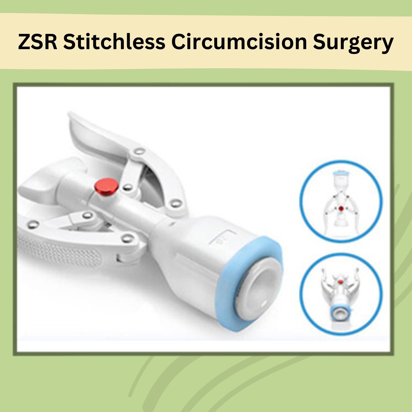 ZSR Stitchless Circumcision Surgery, Bloodless Procedure, Minimal Scarring, Bhachau, Jaipur, Kolhapur, Surat, India.