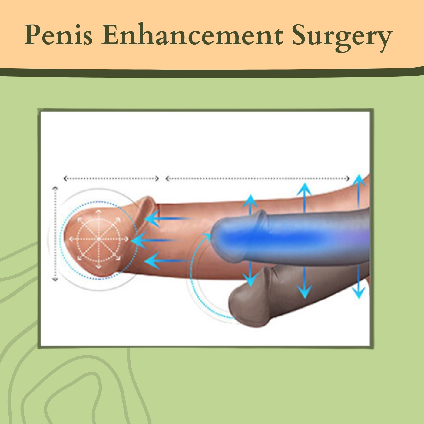 Penis Enhancement Surgery, Penile Lengthening, Anesthesia Procedure, Palanpur, Chapra, Pune, Surat, India. episode artwork