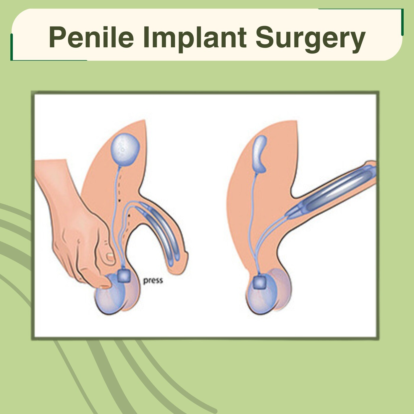Penile Implant Surgery, Penis Reconstruct, Erectile Dysfunction, Rajkot, Darbhanga, Nashik, Surat, India. episode artwork