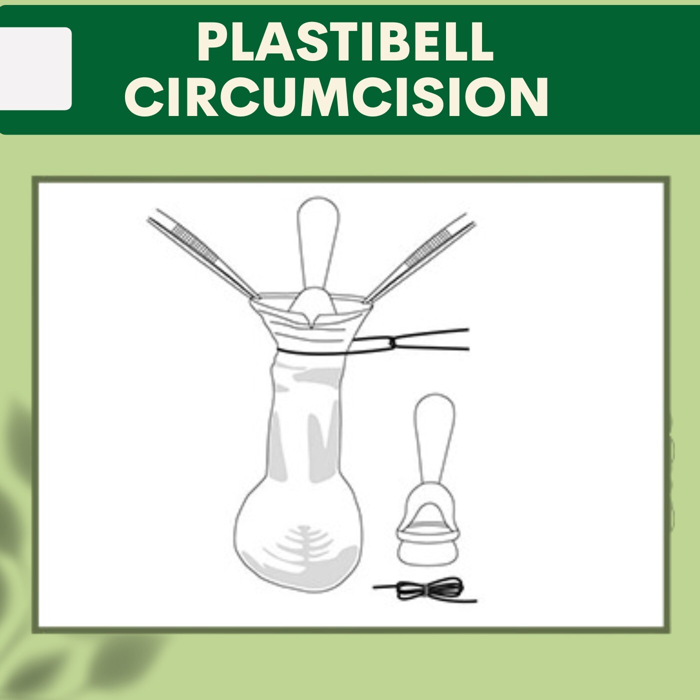 Plastibell Circumcision, Plastibell Device, Surgical Procedure, Bhavnagar, Bhagalpur, Nagpur, Surat, India. episode artwork