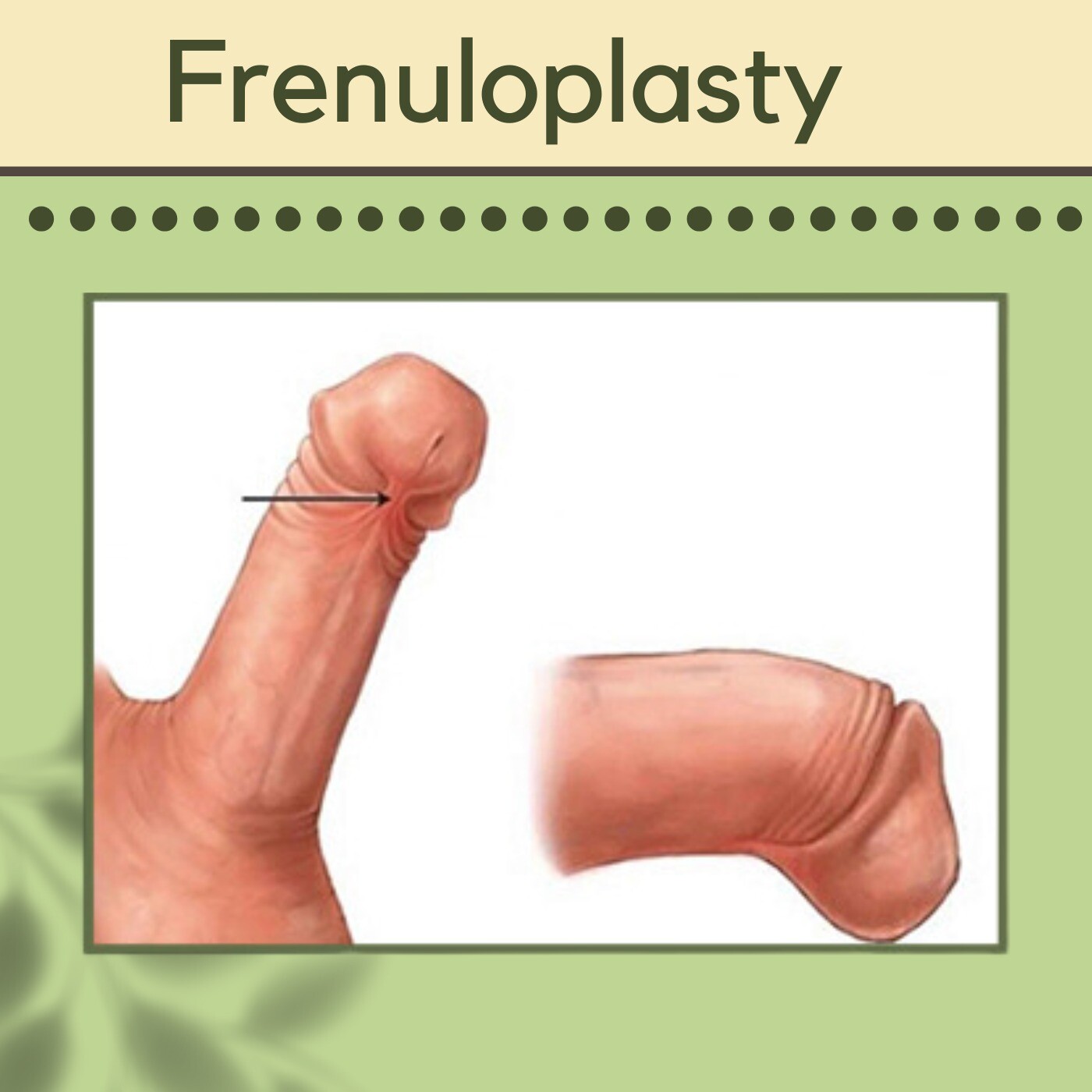 Frenuloplasty, Frenulum Breve, Blood Less Procedure, Ajmer, Junagad, Nagpur, Surat, India. episode artwork