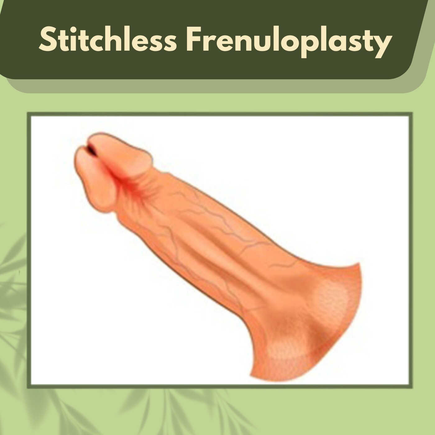 Stitchless Frenuloplasty, Minimally Invasive, Scar Reduction, Jodhpur, Porbander, Mirzapur, Surat, India. episode artwork
