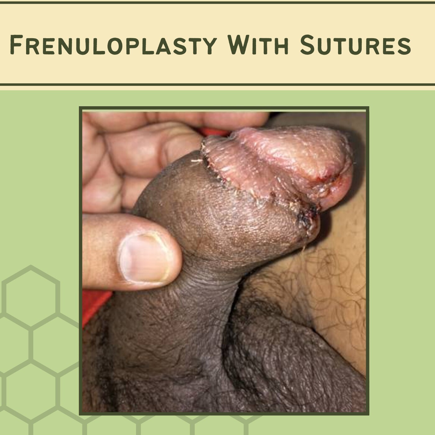 Frenuloplasty With Sutures, Frenular Release, Healing Process, Udaipur, Dwarka, Lucknow, Surat, India.