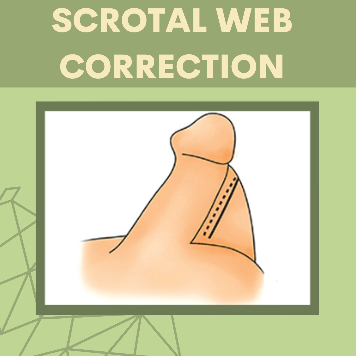 Scrotal Web Correction, Release Scrotal Webbing, Increase Length, Rajkot, Akola, Surat, India. episode artwork