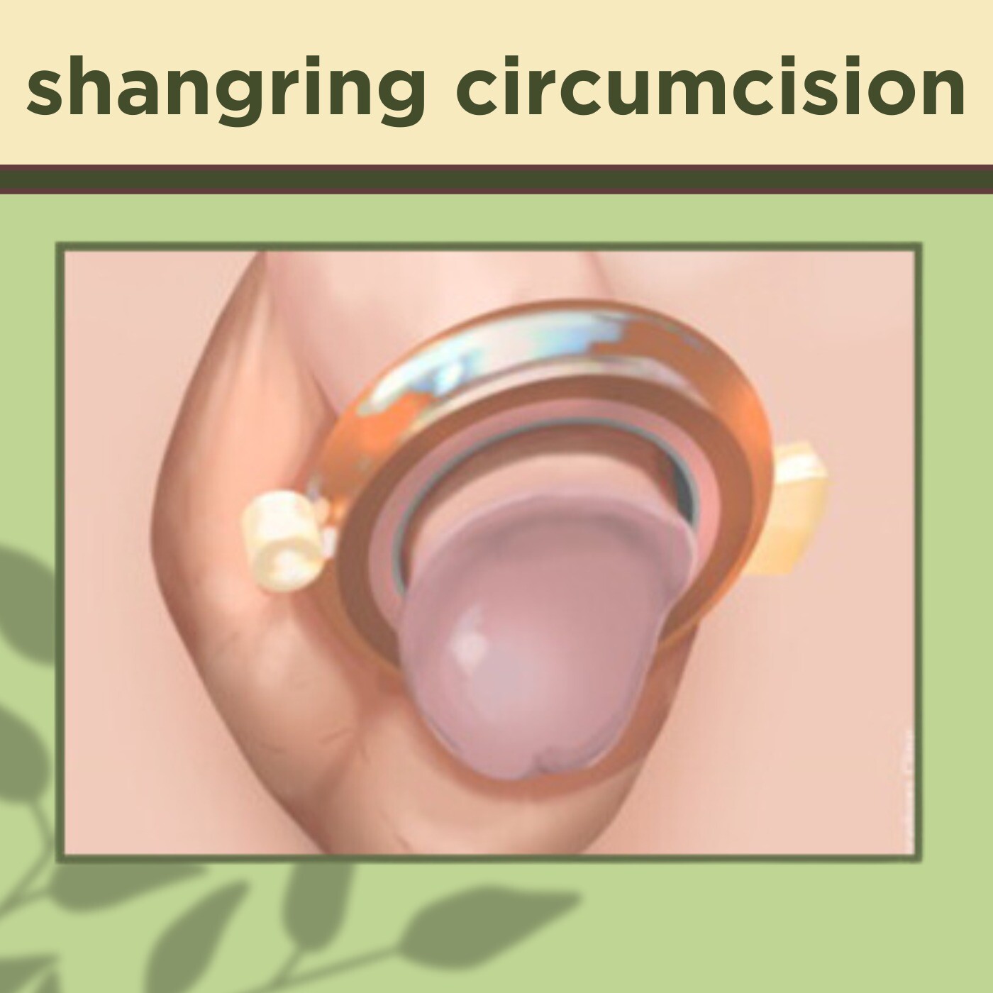 Shangring Circumcision, Stitchless Procedure, Alisklamp Surgery, Gandhidham, Kolhapur, Surat, India. episode artwork