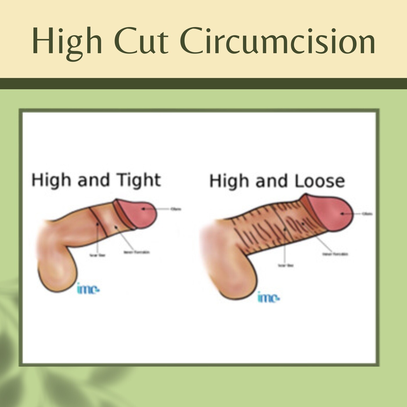 High Cut Circumcision, Foreskin Removal, Cosmetic Circumcision, Dwarka, Shivpuri, Solapur, Surat, India. episode artwork