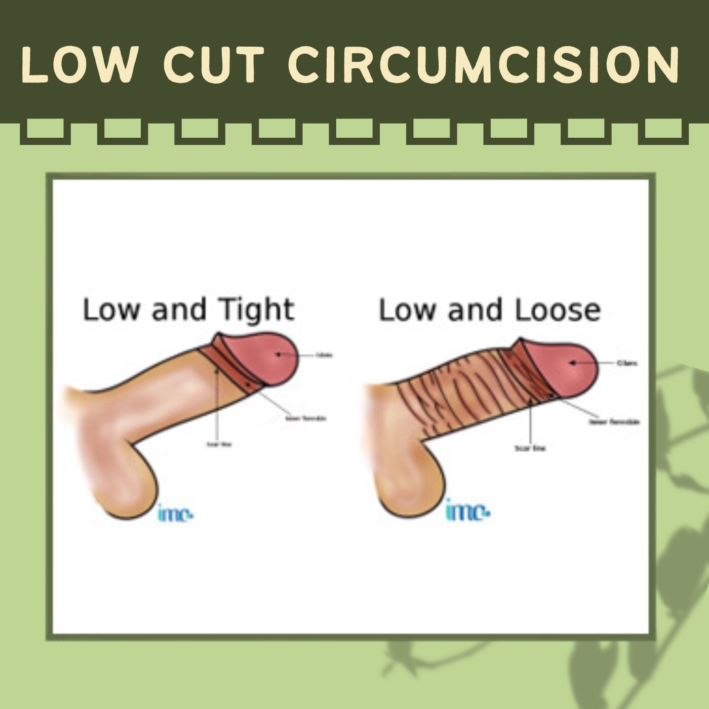 Low Cut Circumcision, Remove Inner Foreskin, Surgical Preferences, Mehsana, Ratlam, Dhule, Surat, India. episode artwork