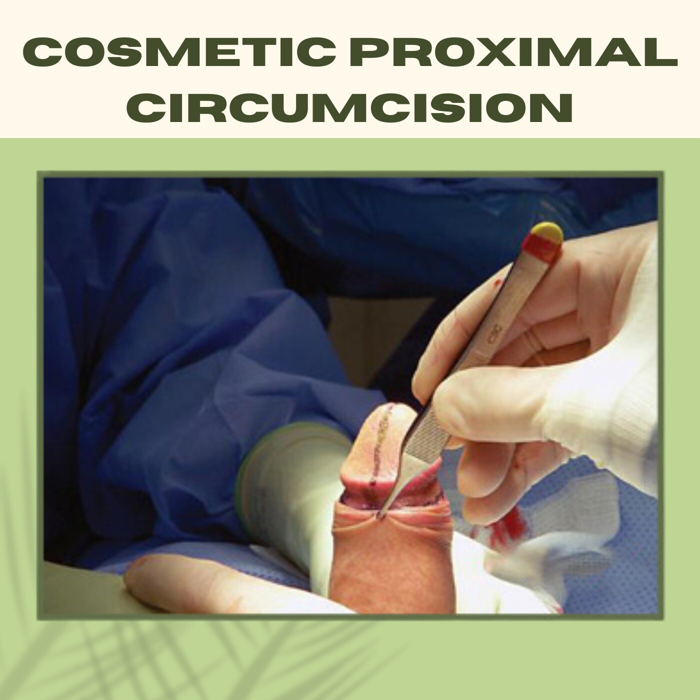 Cosmetic Proximal Circumcision, Penile Appearance, Prepuce Skin Reduction, Mundra, Jamshedpur, Jalna, Surat, India.