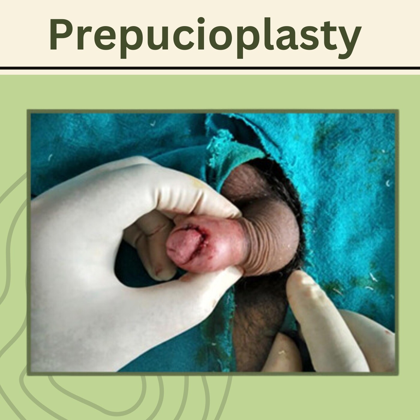 Prepucioplasty, Dorsal Slit Surgery, Z Plasty Procedure, Rajkot, Jalgaon, Bhopal, Surat, India. episode artwork