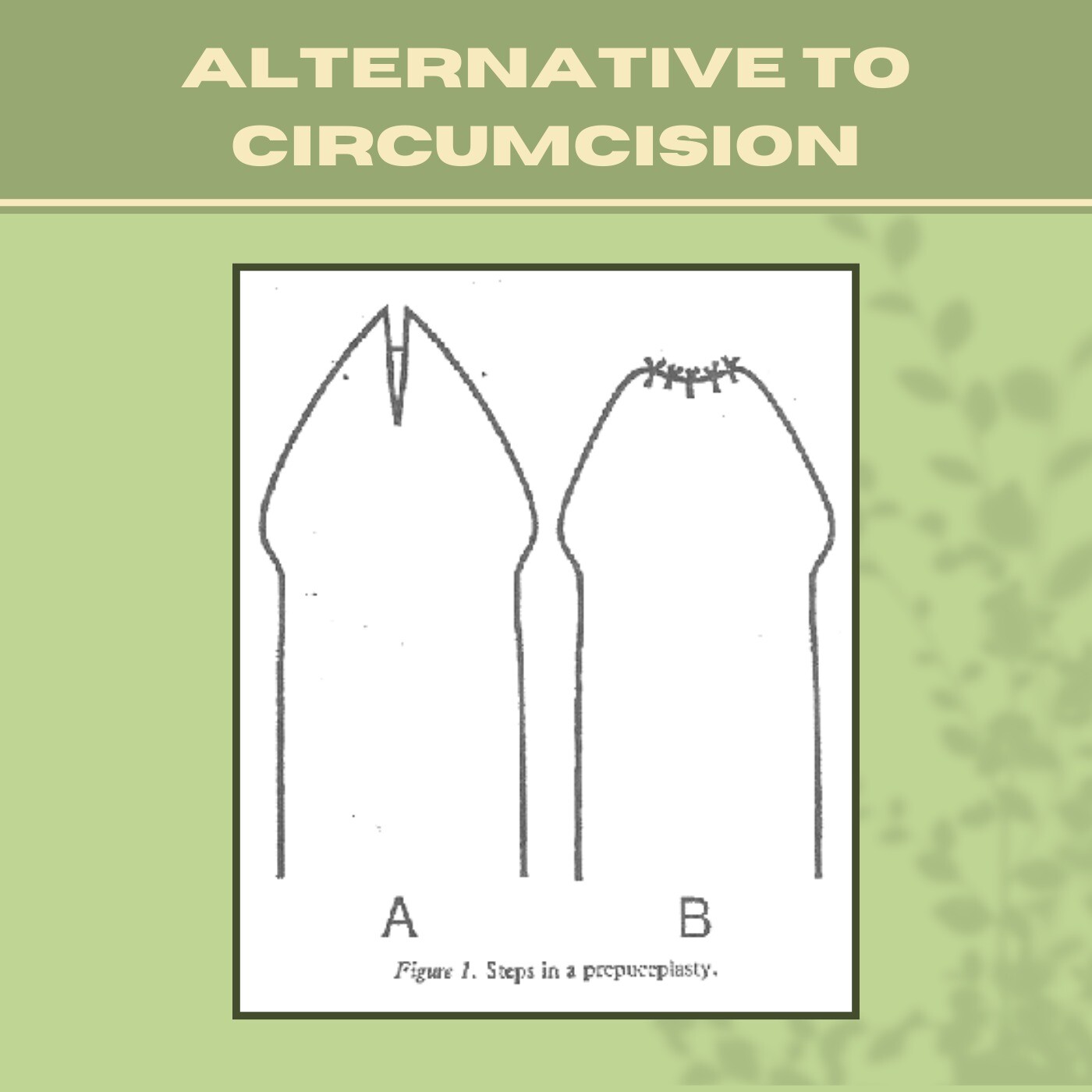 Alternative To Circumcision, Mordred Phimosis, Reduce Scar, Preputioplasty, Jamnagar, Nashik, Bhagalpur, Surat, India.