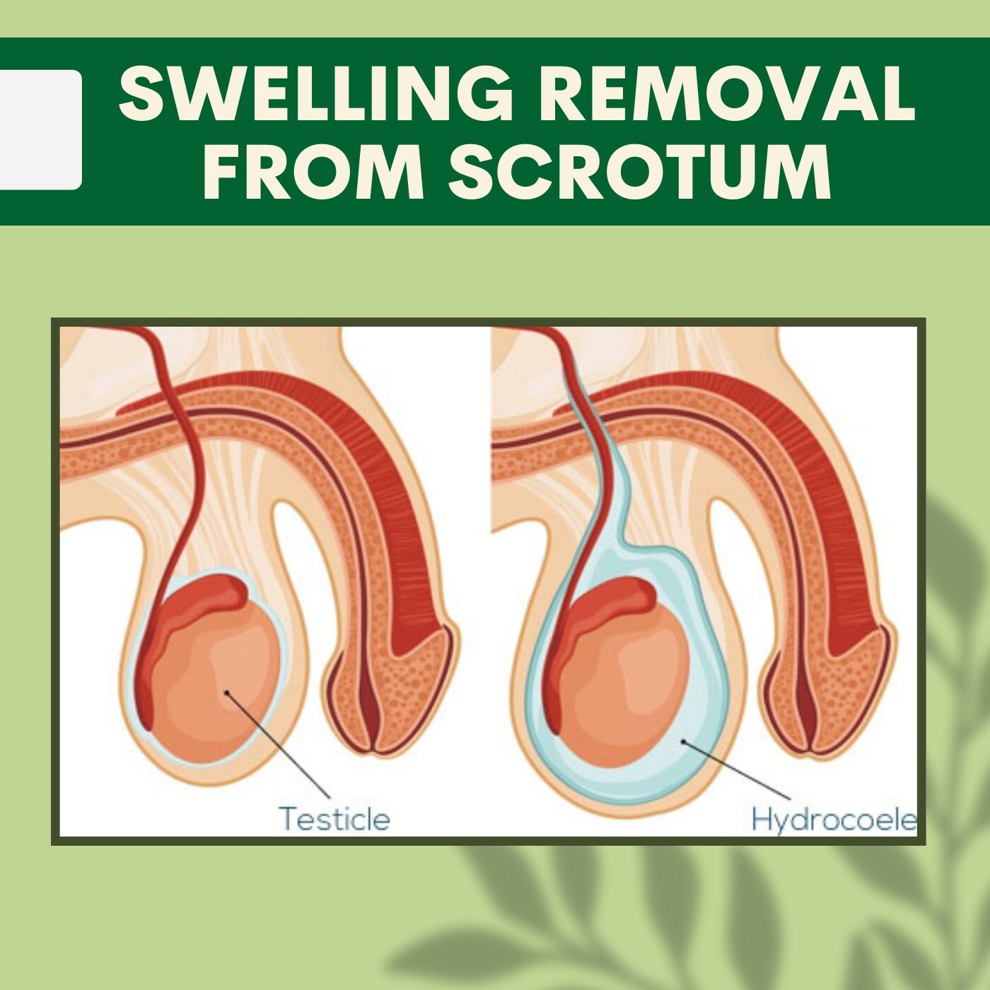 Swelling Removal From Scrotum, Skin Graft Procedure, Scrotal Swelling, Dwarka, Mumbai, Ambikapur, Surat, India. episode artwork