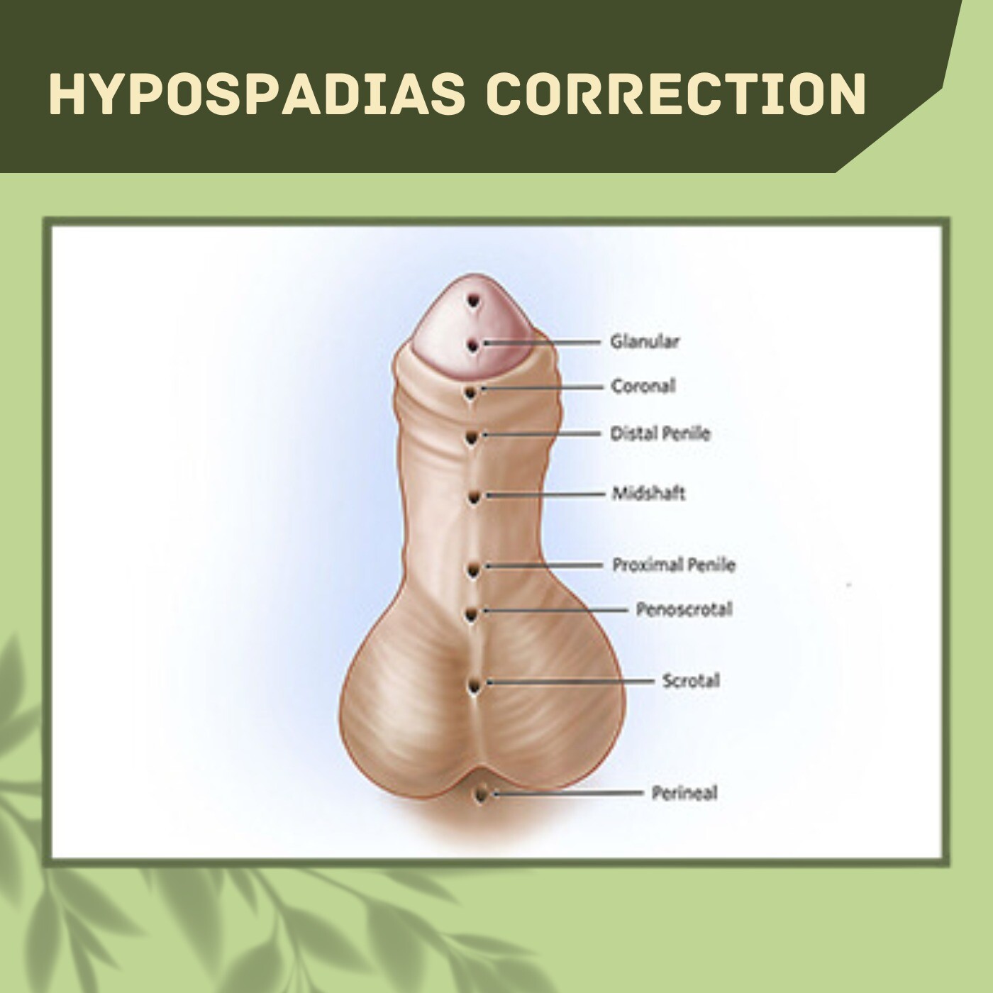 Hypospadias Correction, Urethral Flap Technique, Remove The Excess Foreskin, Bhuj, Pune, Hazaribagh, Surat, India. episode artwork