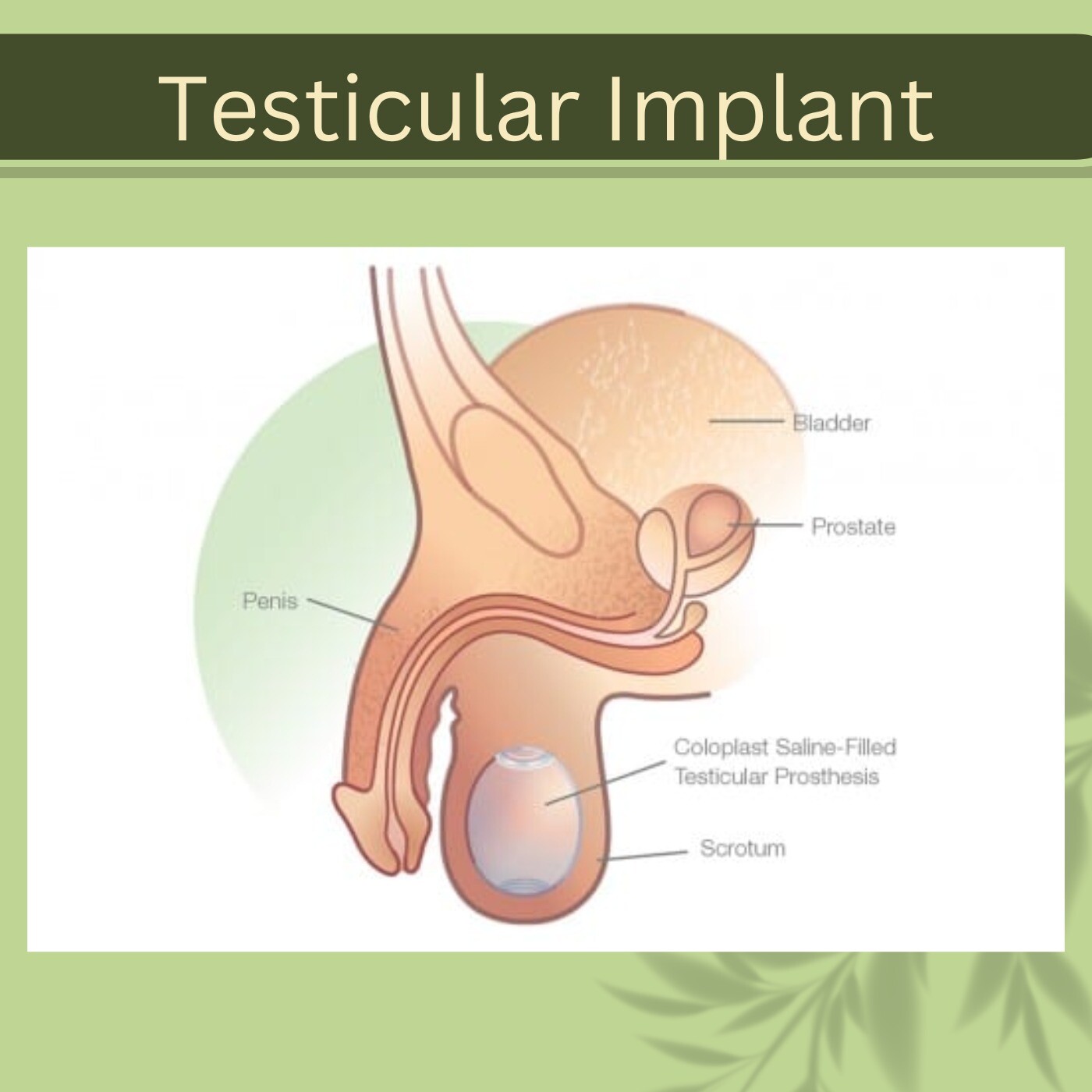 Testicular Implant, Radiation Therapy, Scarless Procedure, Bhachau, Ahmednagar, Ranchi, Surat, India. episode artwork