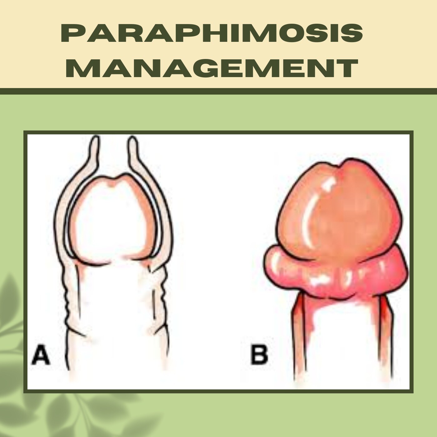 Paraphimosis Management, Prepucioplasty, Circumcision Surgery, Mundra, Jalna, Raipur, Surat, India. episode artwork