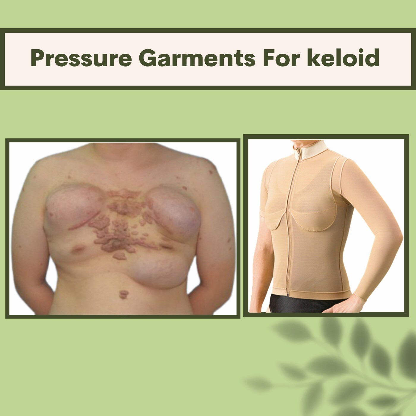 Pressure Garments For Keloid, Scar Management, Compression Garments, Kolhapur, Ambikapur, Mumbai, Surat, India. episode artwork