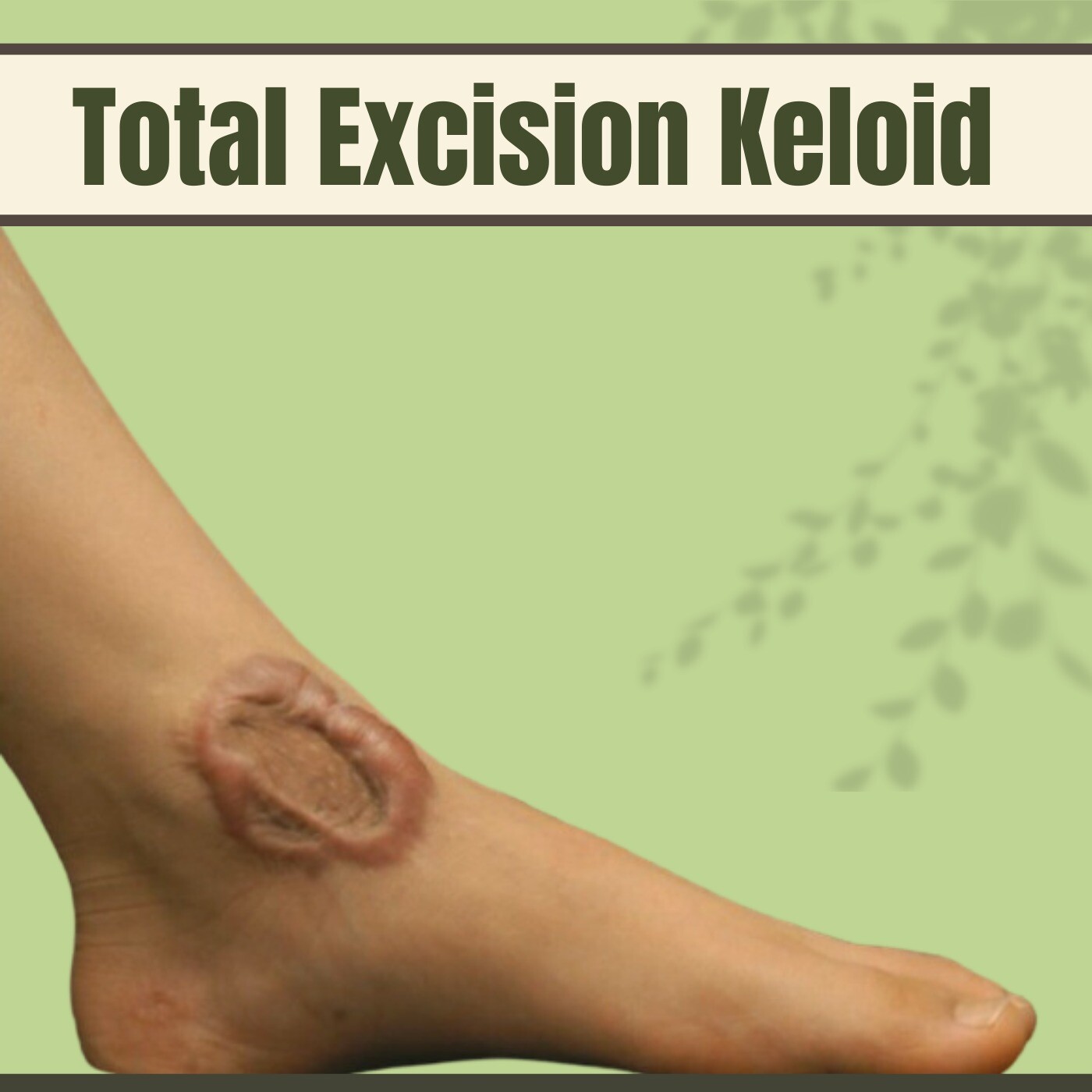 Total Excision, Silicone Sheets, Total Keloid Removal Surgery, Nashik, Himatnagar, Bhagalpur, Surat, India. episode artwork