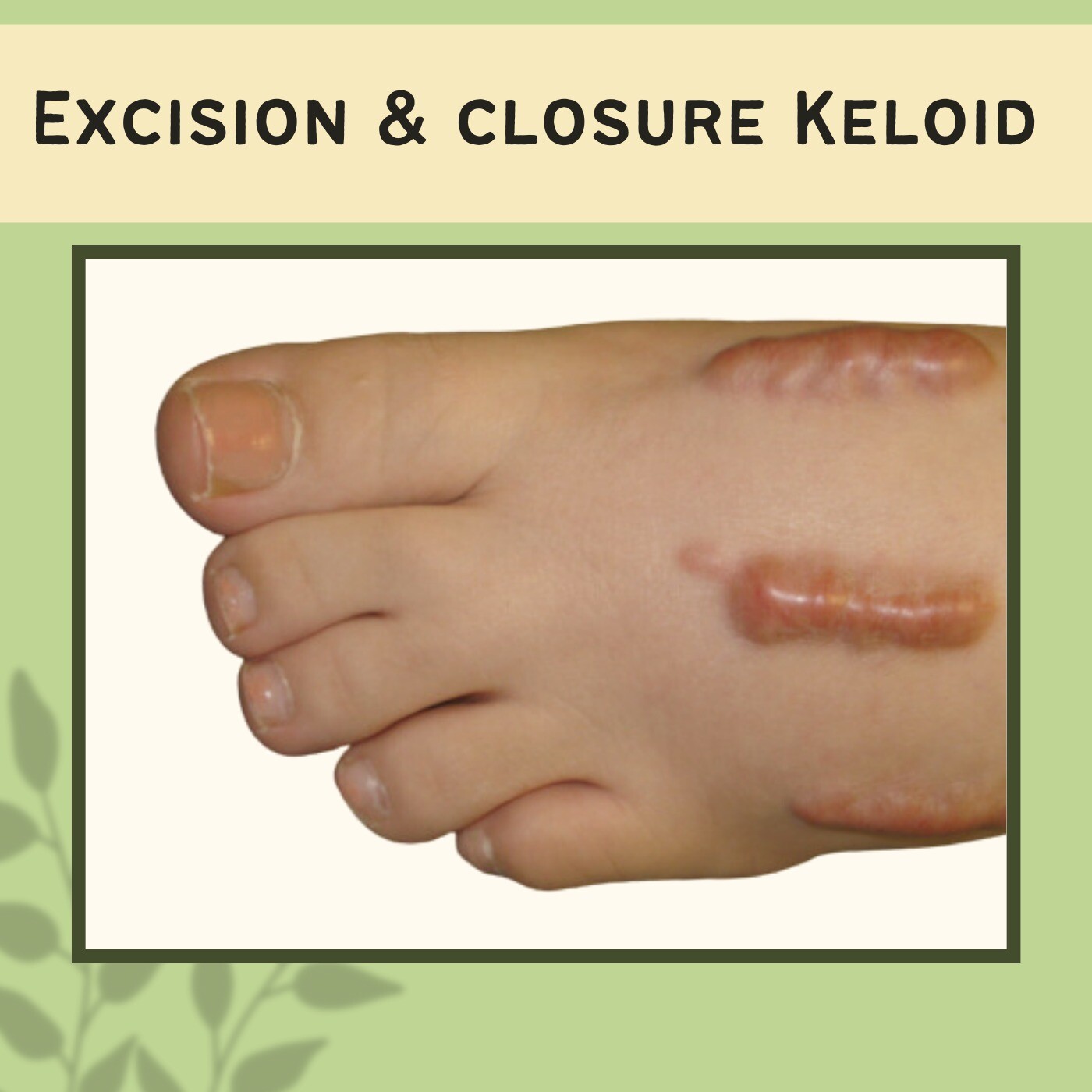 Excision & Closure, Intralesional Injections Procedure, Laser Therapy For Keloid, Mumbai, Mehsana, Darbhanga, Surat, India. episode artwork