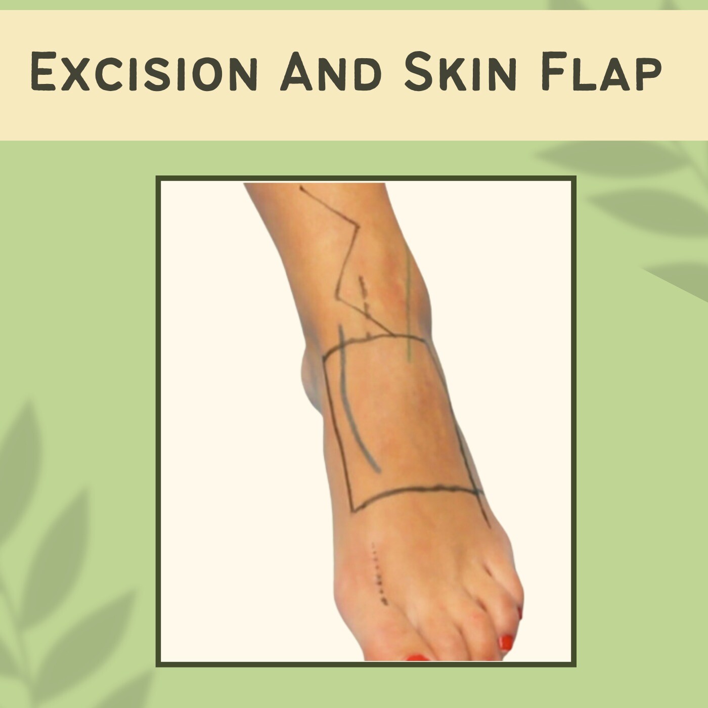 Excision and Skin Flap, Skin Graft For Keloid, Silicone Therapy, Rajkot, Mumbai, Surat, India.