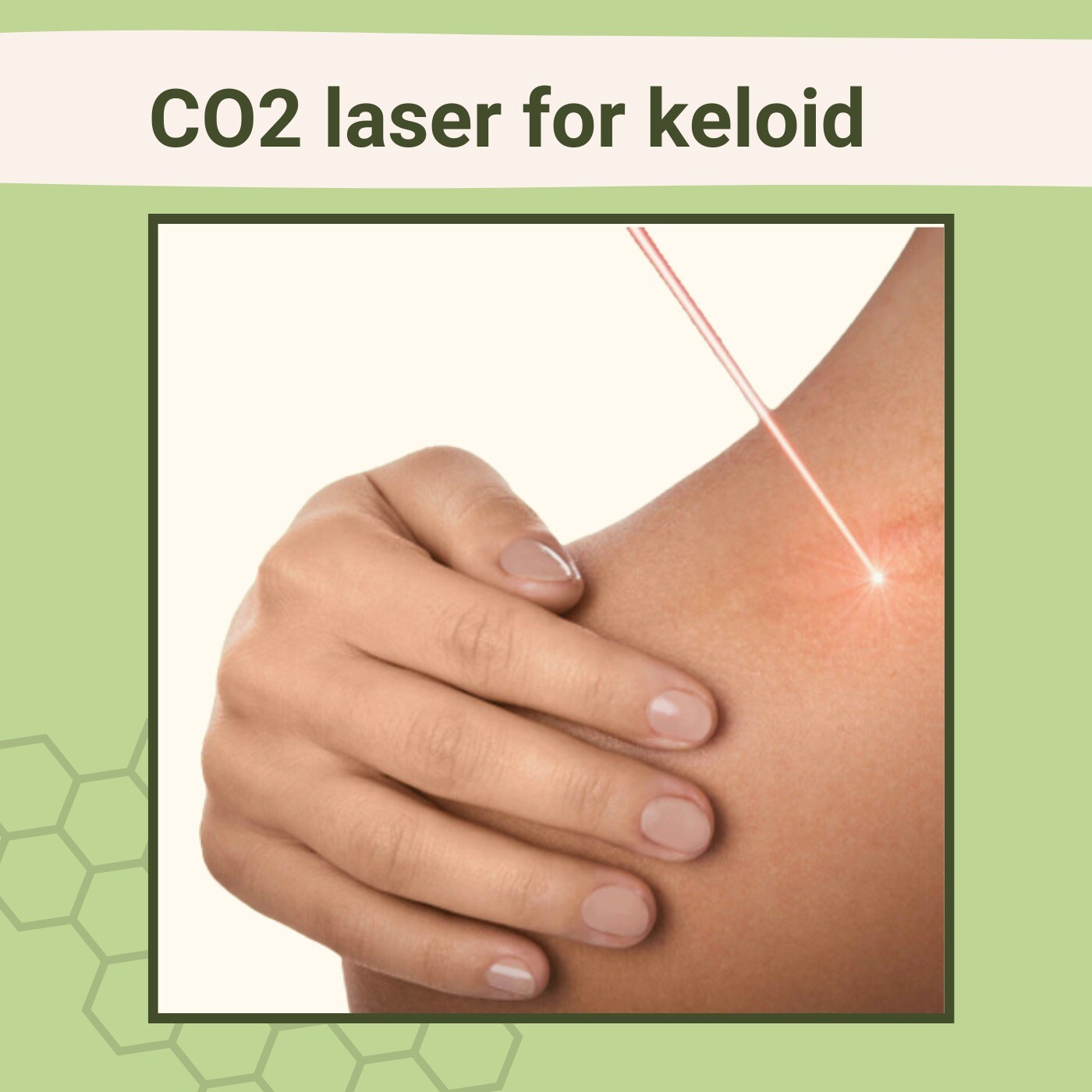 CO2 Laser For Keloid, Silicone Therapy, Diode Hair Removal, Porbander, Aurangabad, Surat, India. episode artwork