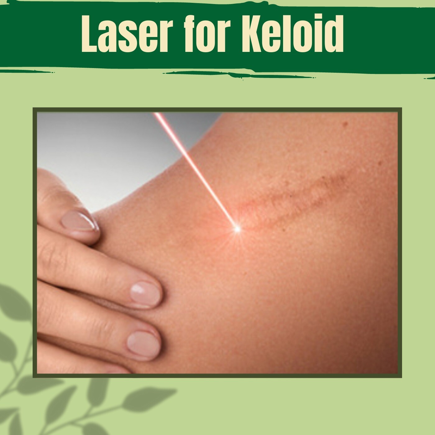 Laser for Keloid, Injection Therapy, Pressure Garment, Diode Hair Removal, Dwarka, Akola, Surat, India.