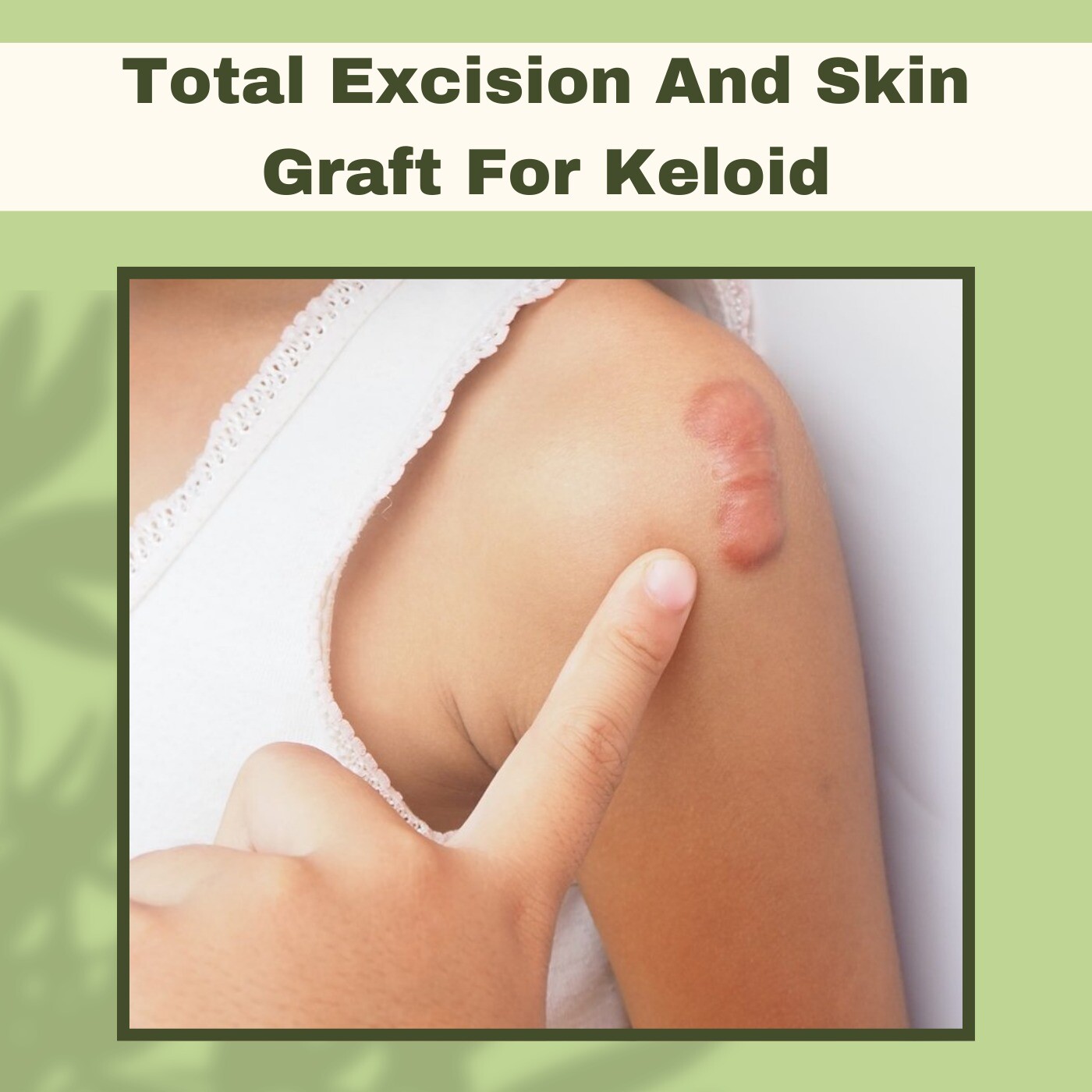 Total Excision and Skin Graft, Postoperative Care For Keloid, Tissue Removal, Mehsana, Latur, Surat, India. episode artwork
