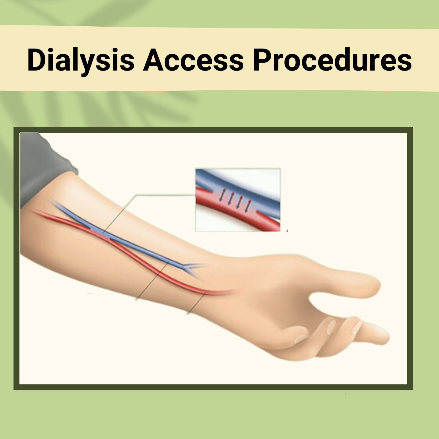 Dialysis Access Procedures, Arteriovenous Fistula, Dialysis Access Machine, Bhuj, Jodhpur, Latur, Surat, India. episode artwork