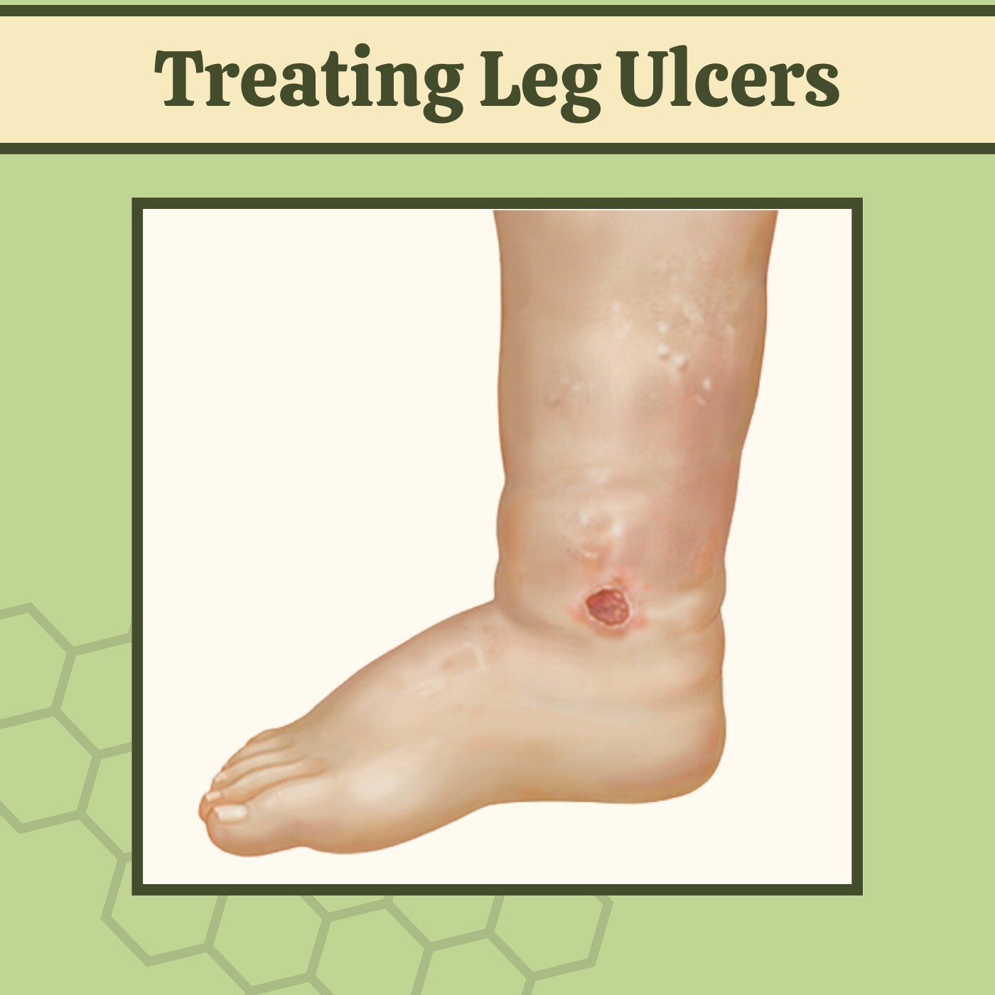 Treating Leg Ulcers, Non Healing Ulcers, Antibiotics, Gandhidham, Udaipur, Satara, Surat, India. episode artwork