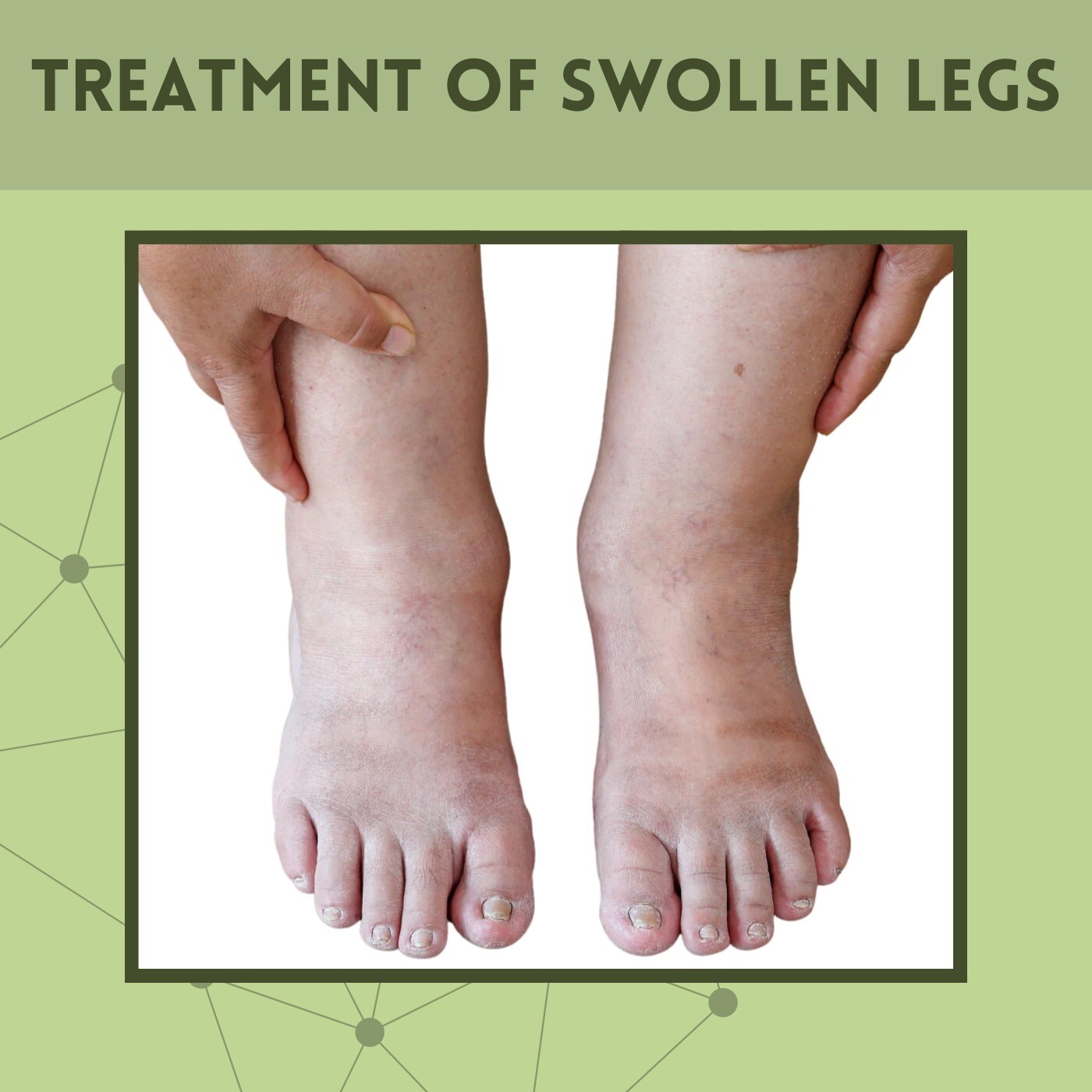 Treatment Of Swollen Legs, Edema, Varicose Veins, Rajkot, Kolhapur, Bhagalpur, Surat, India. episode artwork