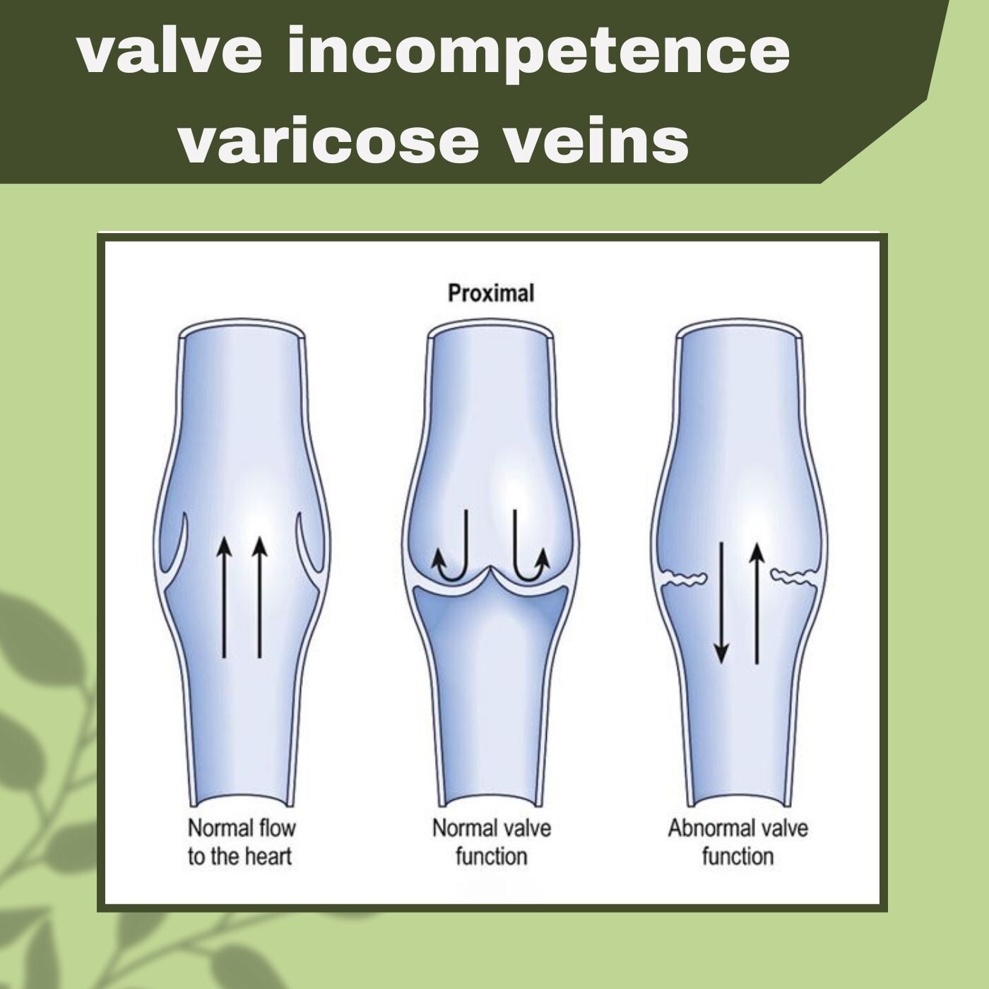 Valve Incompetence Varicose Veins, Blood Circulation, Leg Swelling, Bhavnagar, Dhule, Udaipur, Surat, India. episode artwork
