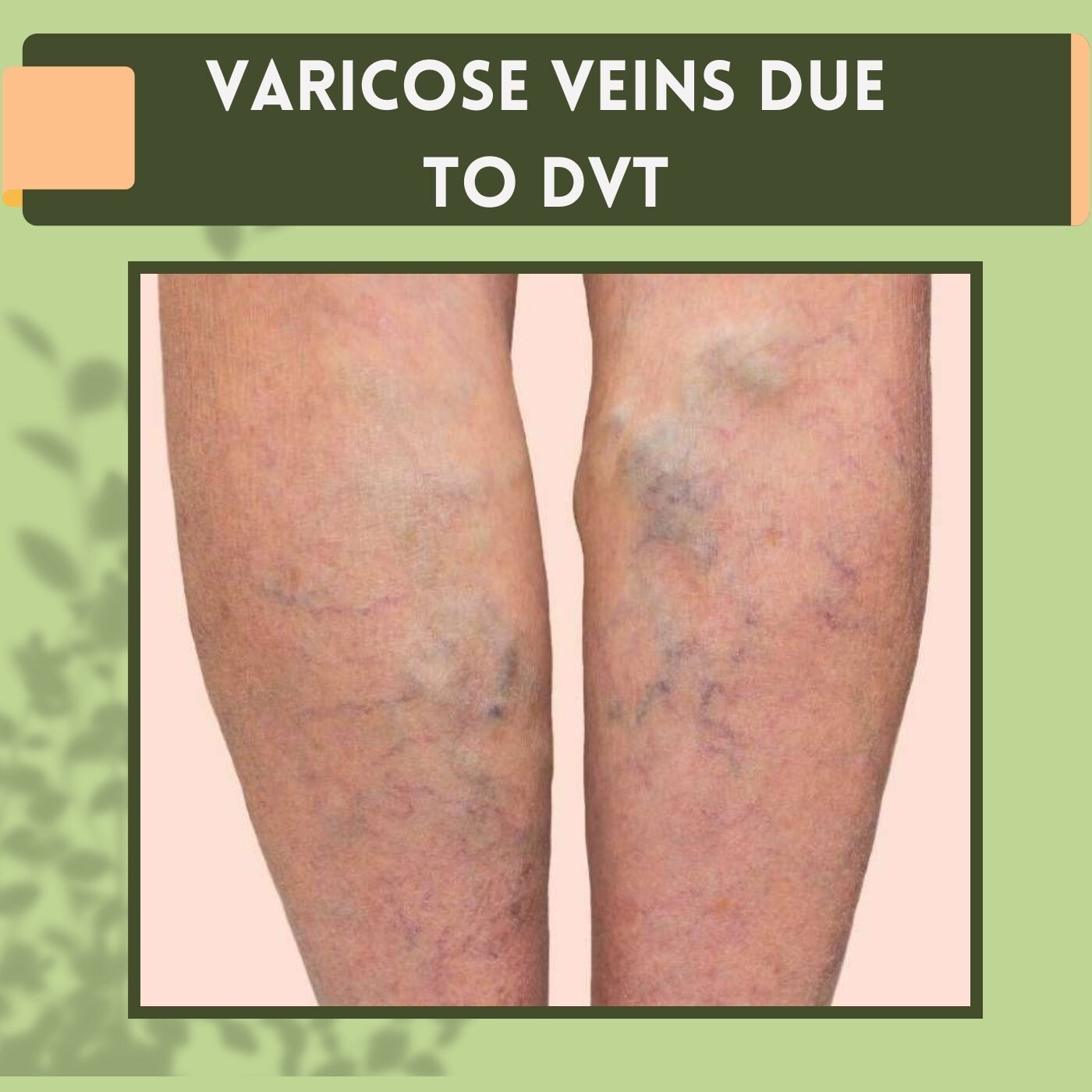 Varicose Veins Due To DVT, Blood Clot, Vascular Health, Rajkot, Gwalior, Lucknow, Surat, India. episode artwork
