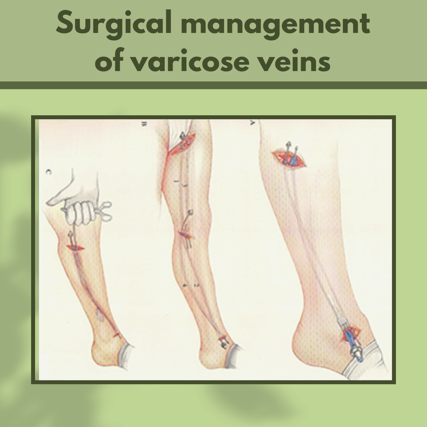 Surgical Management Of Varicose Veins, Blood Saphenous, Short Saphenous Vein, Palanpur, Ambikapur, Nashik ,Surat, India. episode artwork