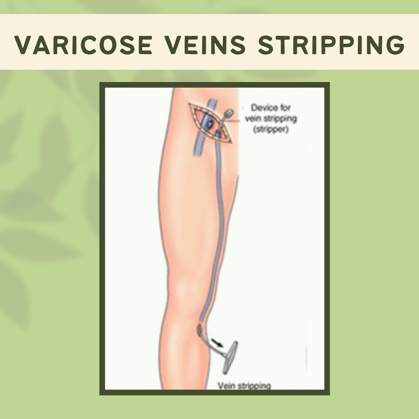 Varicose Veins Stripping, Vascular Surgery, Vein Removal, Leg Veins, Gandhinagar, Hazaribagh, Mumbai, Surat, India. episode artwork