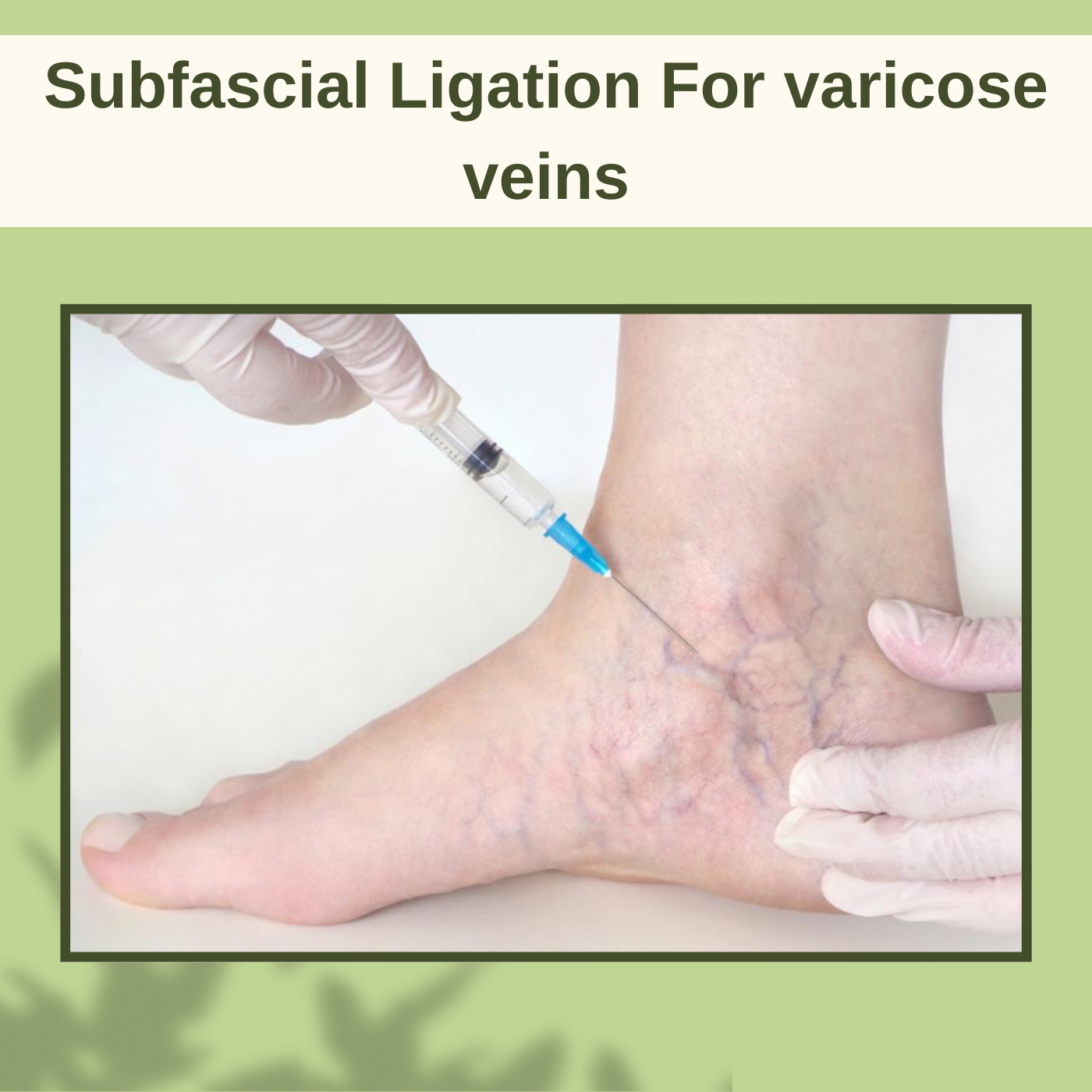 Subfascial Ligation For Varicose Veins, Vein Ligation, Lacer Treatment, Anesthesia Procedure, Vadodara, Ranchi, Pune, Surat, India. episode artwork