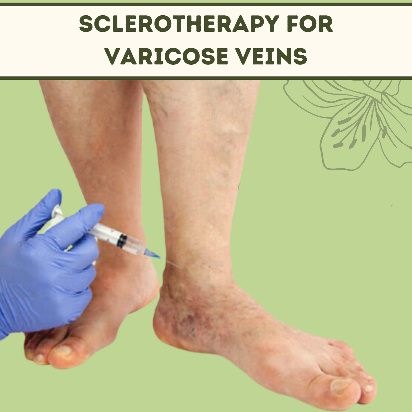 Sclerotherapy For Varicose Veins, Laser Treatment, Spider Veins, Himatnagar, Bhilwara, Satara, Surat, India. episode artwork